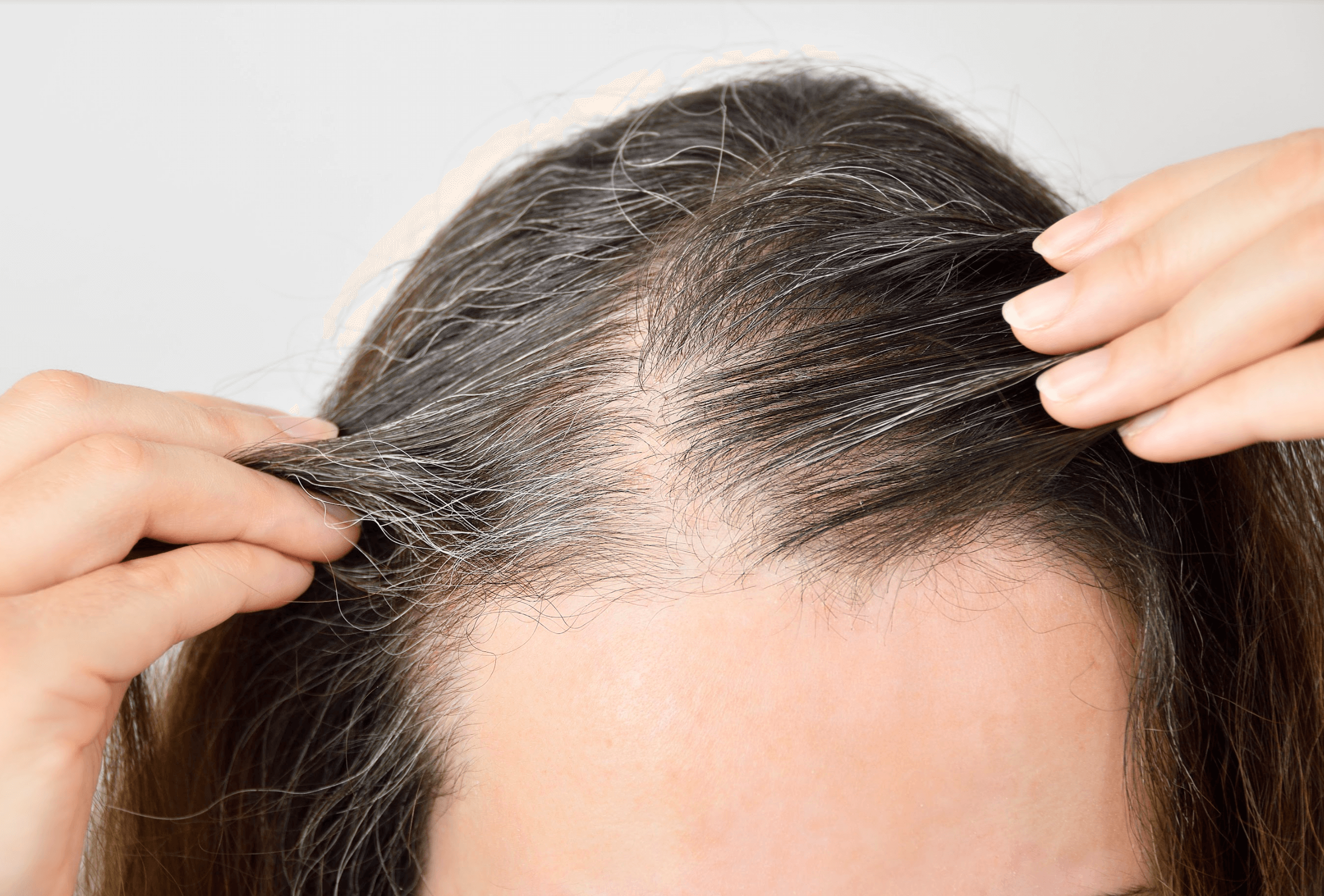PRF Injections for Hair Loss Before  After